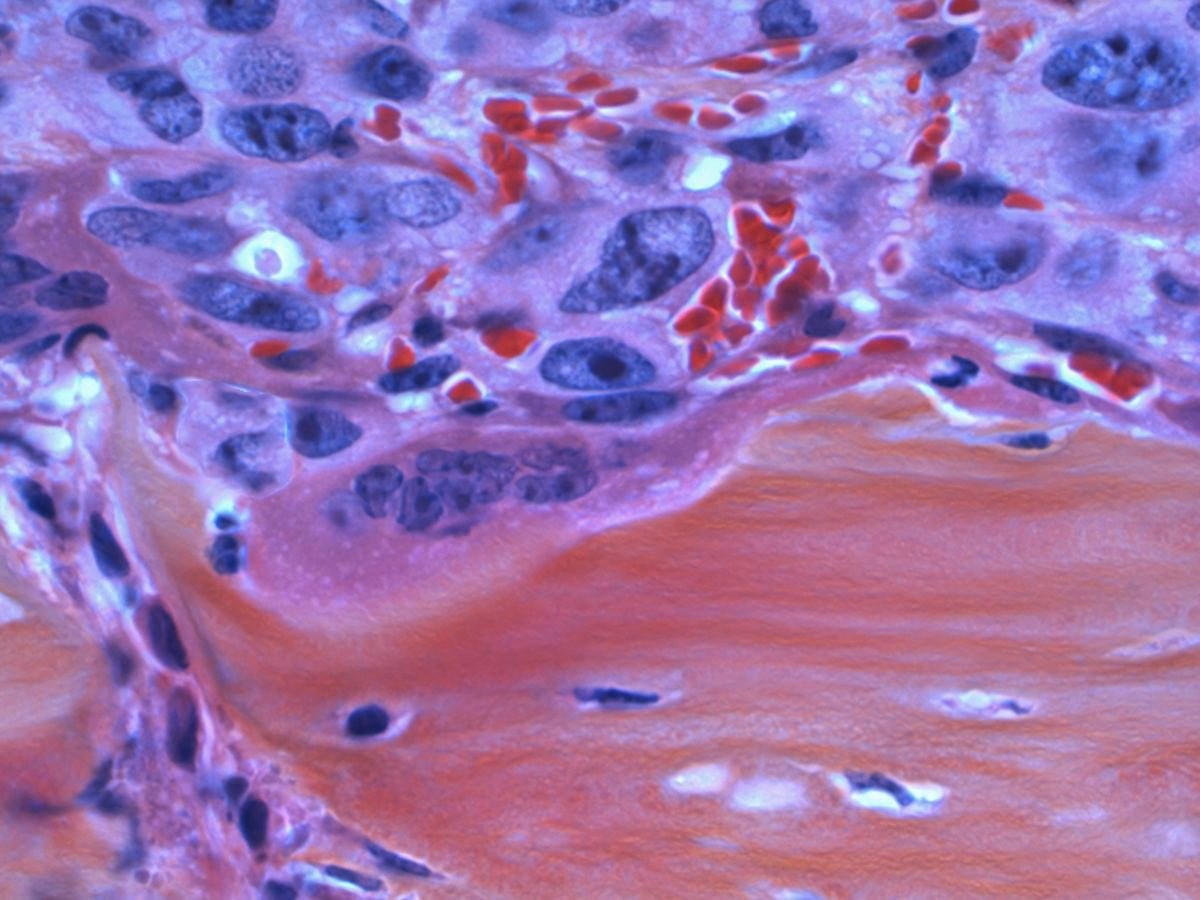 Microscope image of cancer spreading to bone.
