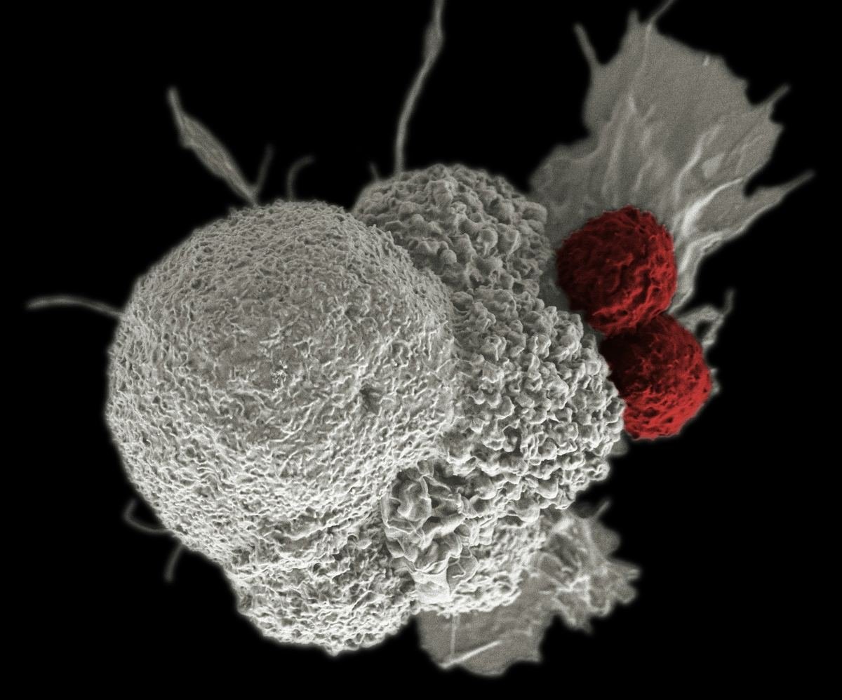 Electron micrograph of an oral squamous cancer cell surrounded by immune cells.