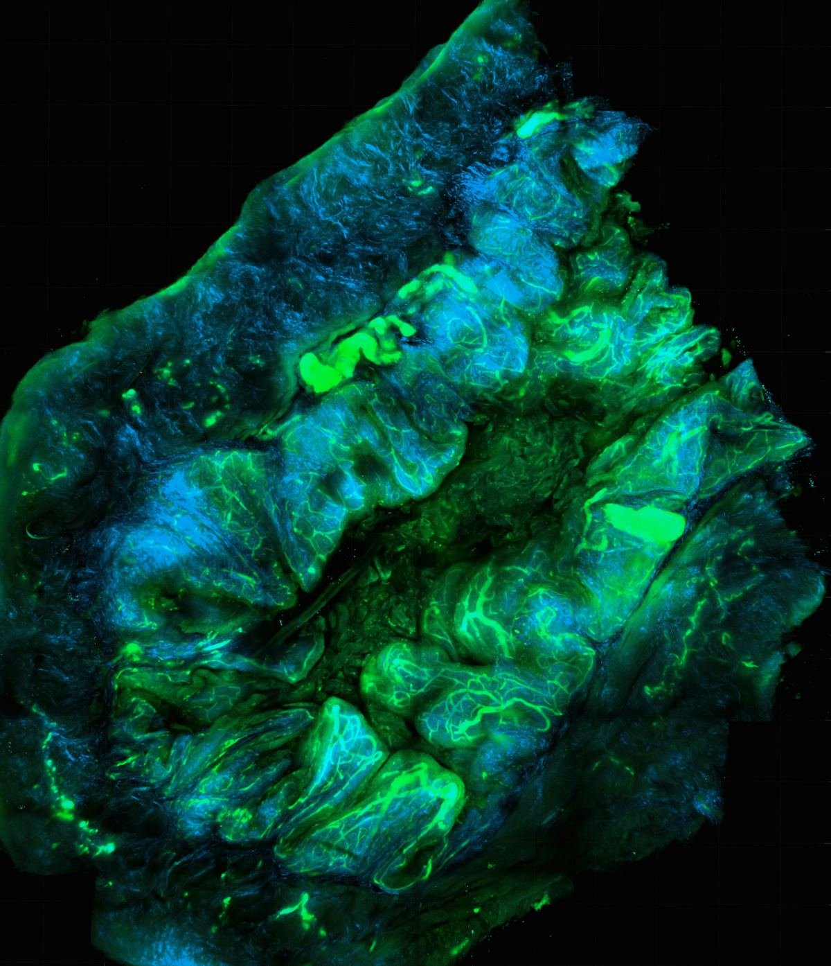 Microscope image of an ovarian tumour and its surrounding tissue.