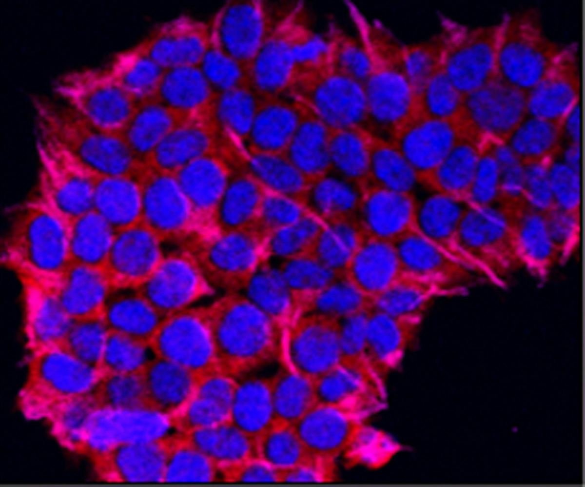 Microscope image of cancer cells stained purple and red.