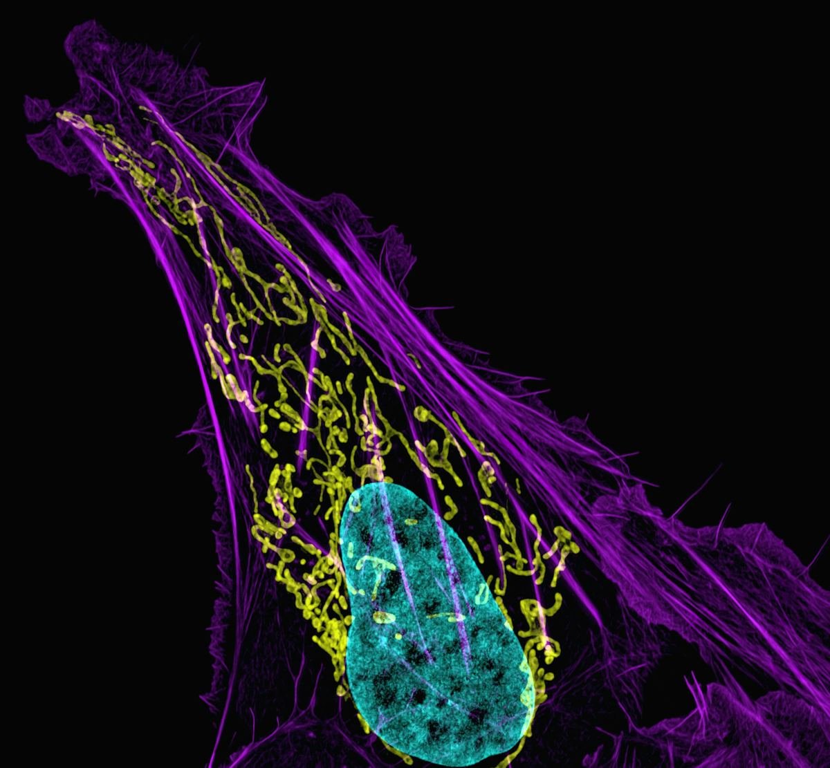 Microscope image of an osteosarcoma bone cancer cell.