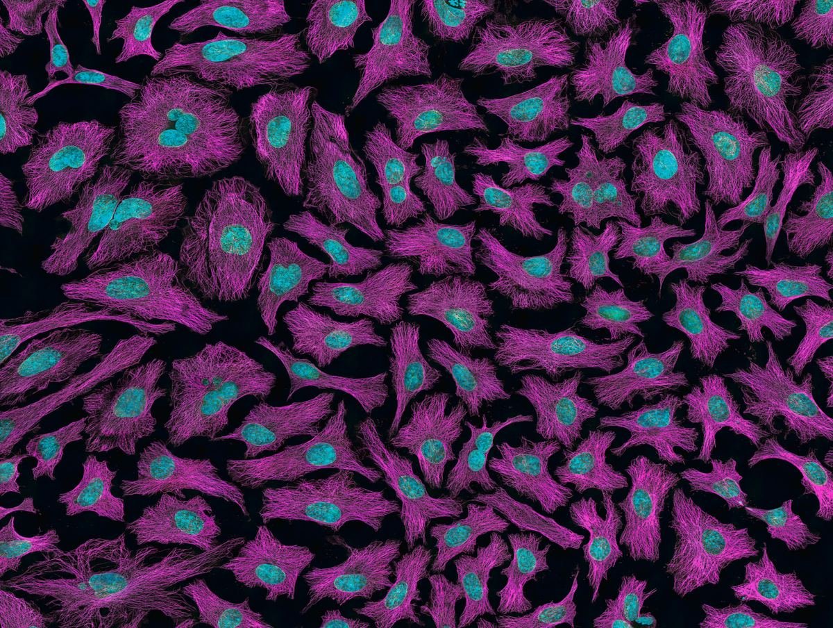 Microscope image of cancer cells in pink and blue.